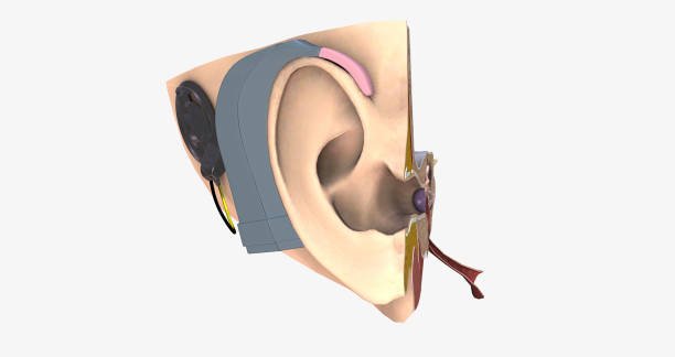 cochlear implant